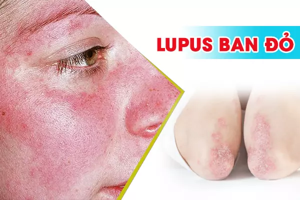 Lupus ban đỏ