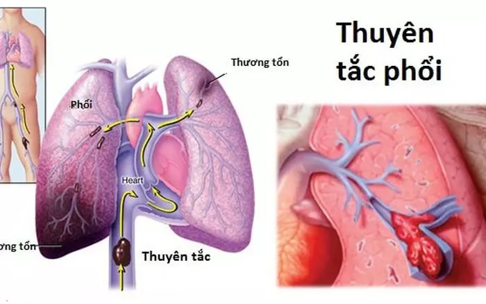 Thuyên tắc động mạch phổi