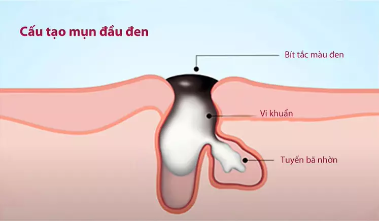 Nhân mụn to ra sẽ làm lỗ chân lông mở rộng