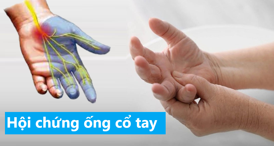 Hội chứng ống cổ tay là gì? Làm sao để cải thiện?