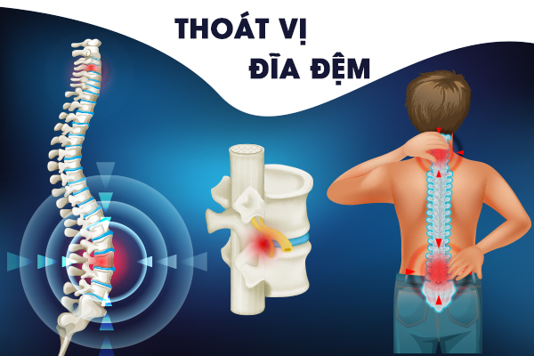 Bệnh thoát vị đĩa đệm