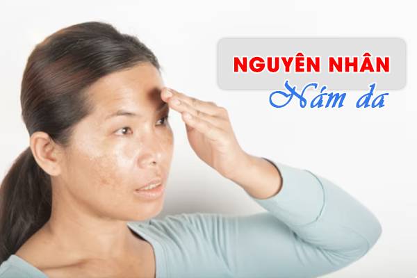 Tại sao bạn bị nám da? Trị nám da bằng cách nào?