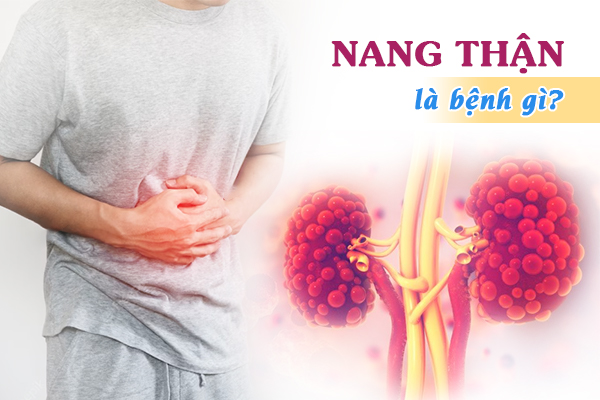 Nang thận là bệnh gì