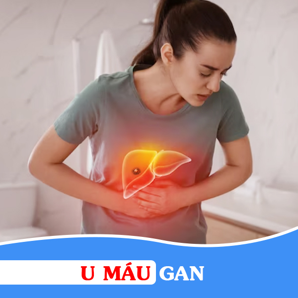 U máu gan là bệnh gì? Có nguy hiểm không và điều trị như thế nào?