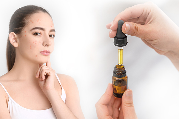 Nên chọn serum trị thâm mụn như thế nào?