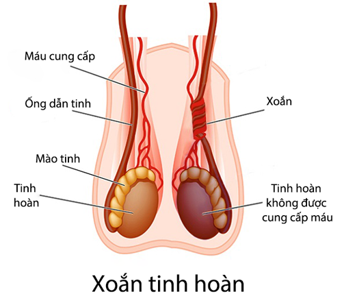 Nam giới đau bụng dưới bên trái có thể do xoắn tinh hoàn.