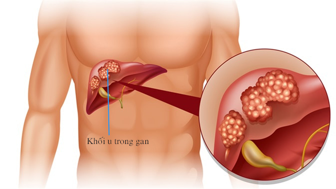 Bệnh nhân gan nhiễm mỡ có thể gặp biến chứng ung thư gan