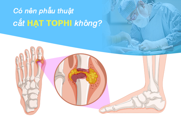 Có nên phẫu thuật cắt hạt tophi không?