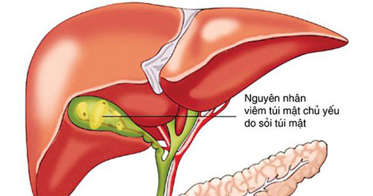 Sỏi túi mật là nguyên nhân chủ yếu gây viêm túi mật