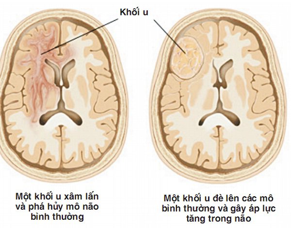 U não ác tính có chữa được không?