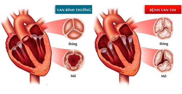 Hở van tim là gì