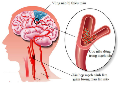 Thiếu máu não - Nguyên nhân, triệu chứng, cách điều trị