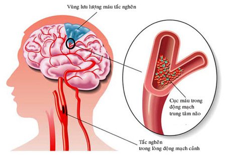 Rung nhĩ có thể dẫn đến đột quỵ