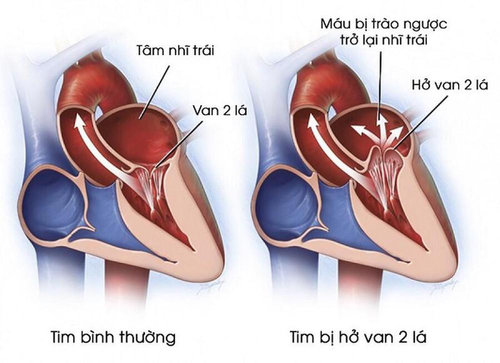 Hở van 2 lá: Nguyên nhân, triệu chứng và cách điều trị