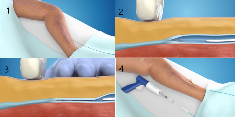 4 bước thực hiện phương pháp bơm keo sinh học