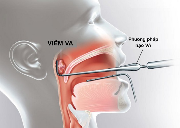 Mô phỏng phương pháp nạo VA