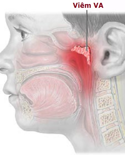 Vị trí VA và hình ảnh viêm VA