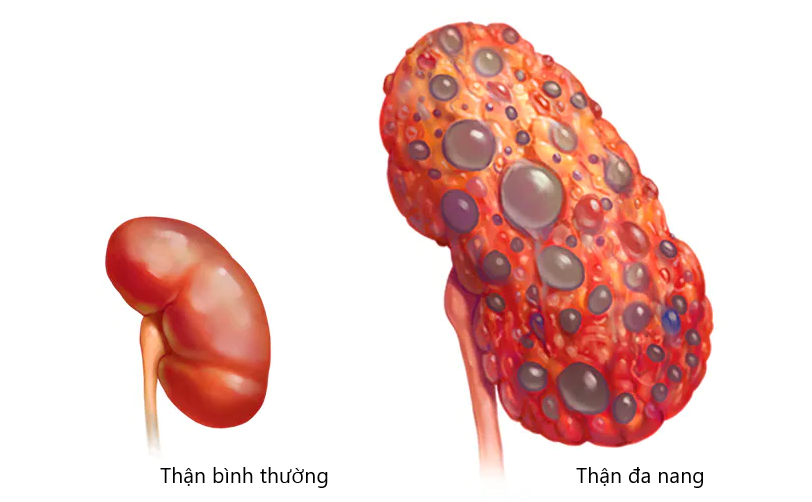 Thận đa nang là bệnh gì?