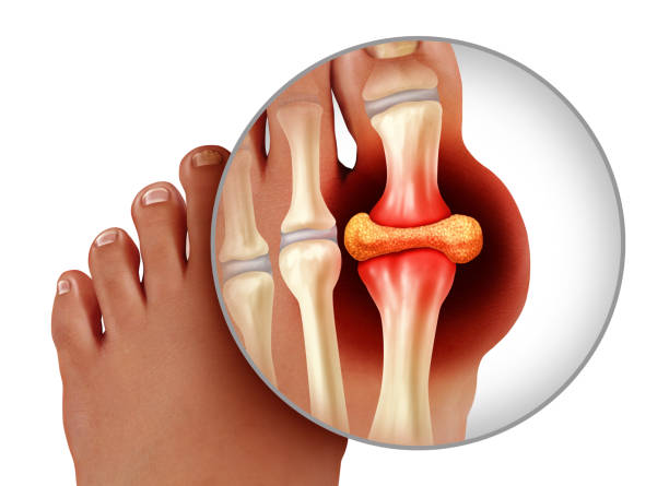 Có những loại thuốc trị gout nào thường được sử dụng?