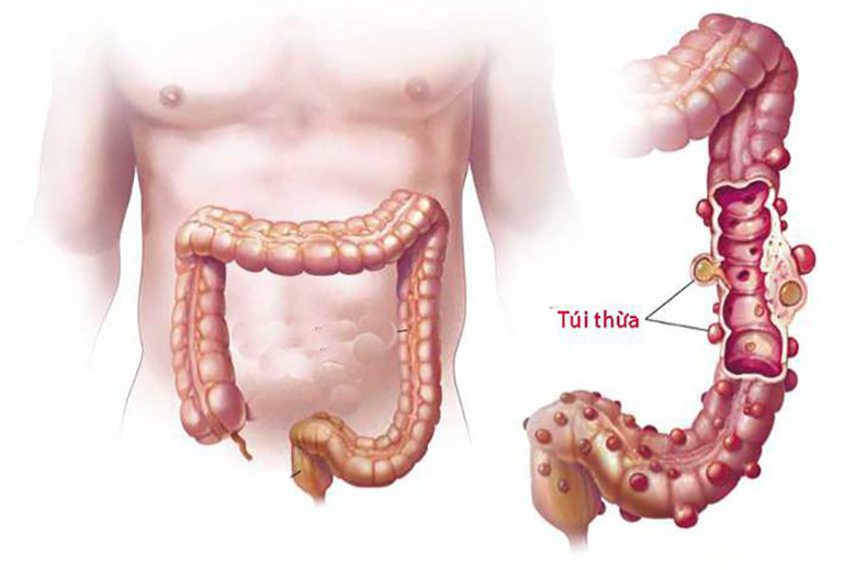 Viêm túi thừa có thể gây chảy máu hậu môn.