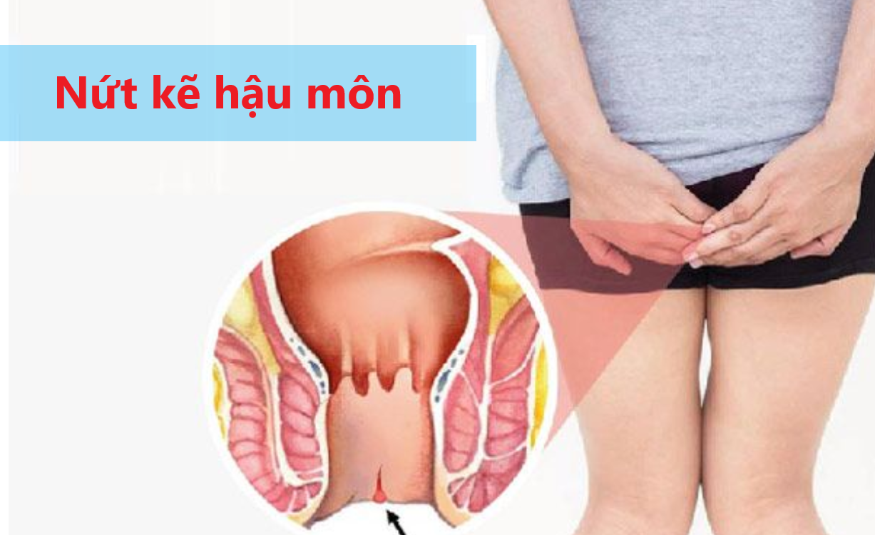 Nứt kẽ hậu môn là bệnh gì?