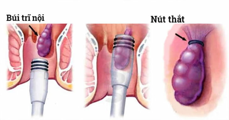 Một lần điều trị có thể thắt 1-3 búi trĩ