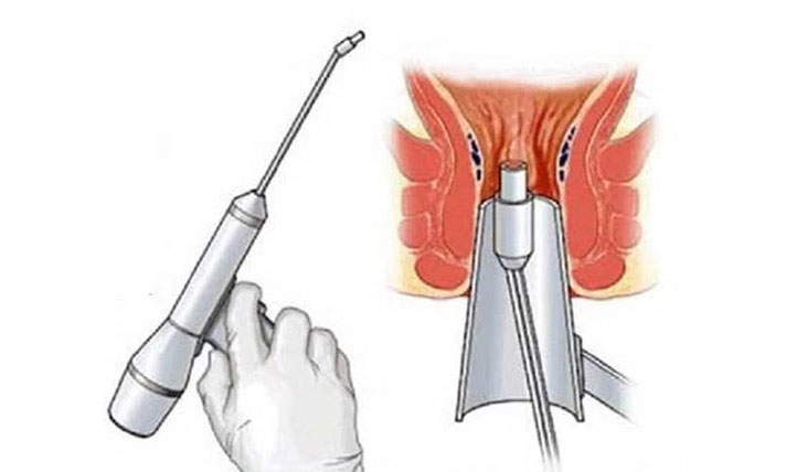 Minh họa cắt trĩ bằng laser