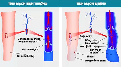 suy giãn tĩnh mạch chân