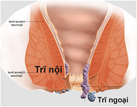 Cách điều trị trĩ nội độ 3 hiệu quả