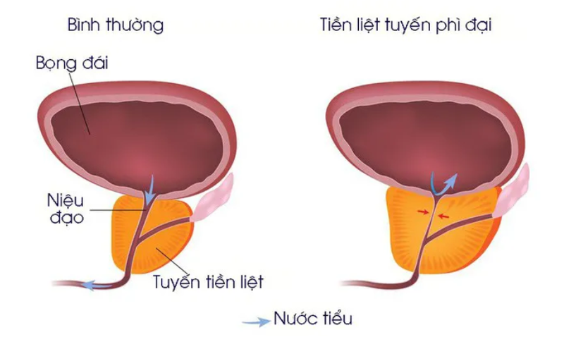 phì đại tiền liệt tuyến