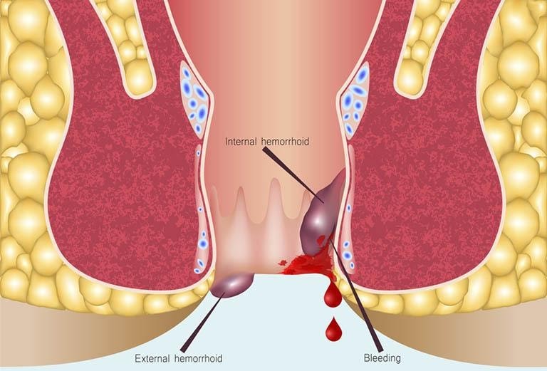 Xử trí chảy máu do vỡ búi trĩ tại nhà