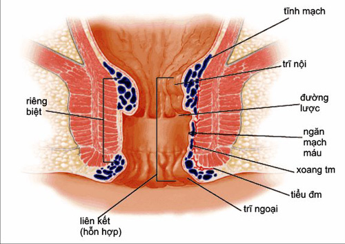 Tổng quan về trĩ ngoại